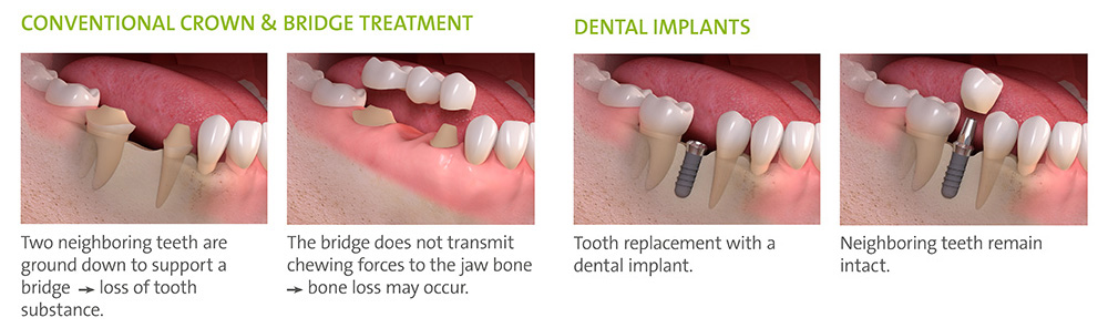 bridge or implant